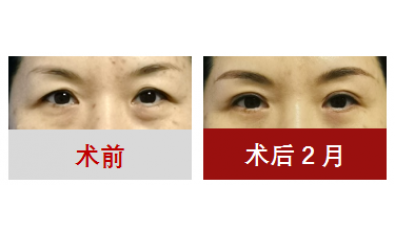 定制化眼周年轻化方案：从松弛凹陷到紧致饱满的精准重塑